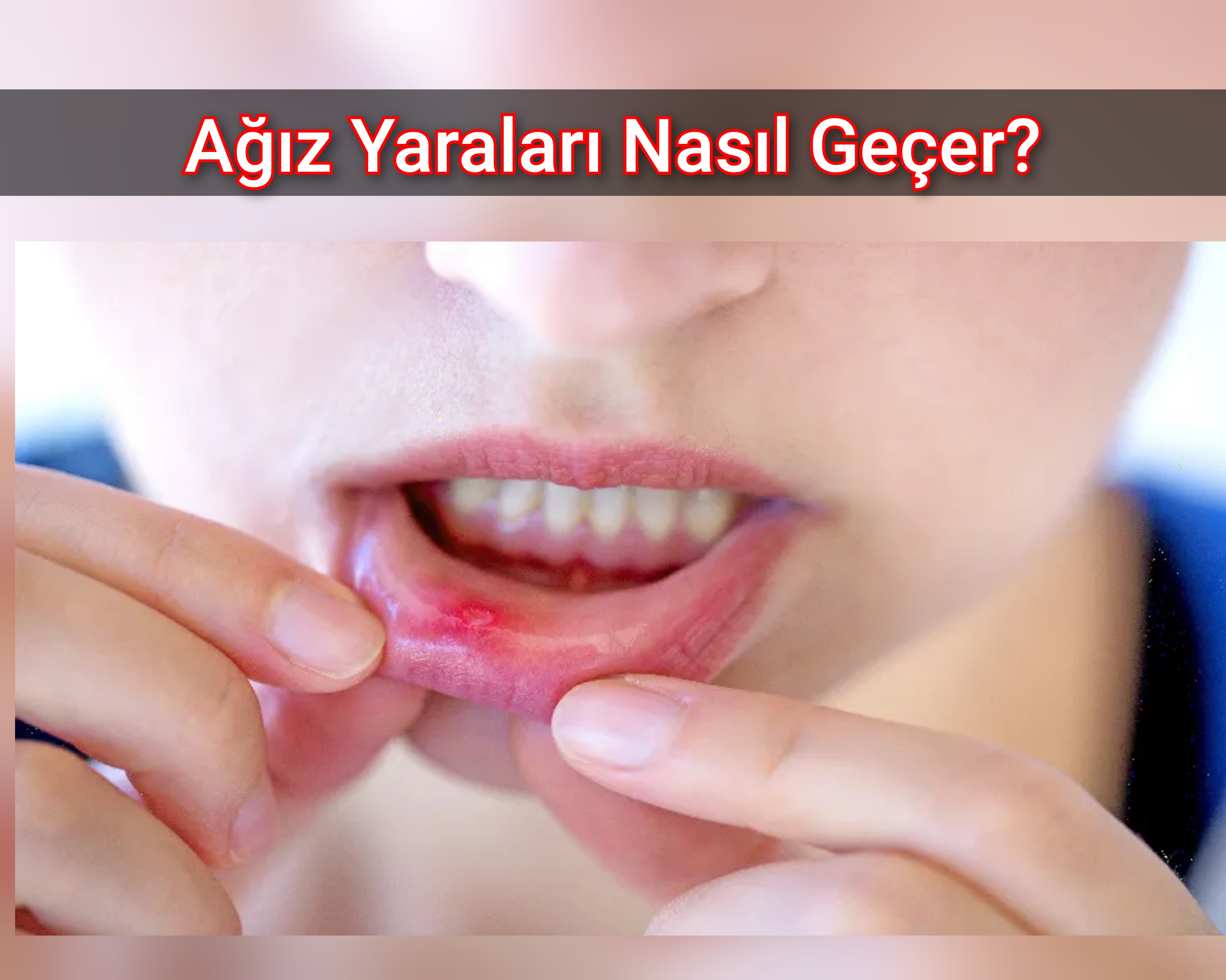 Ağız Yaraları Nasıl Geçer?