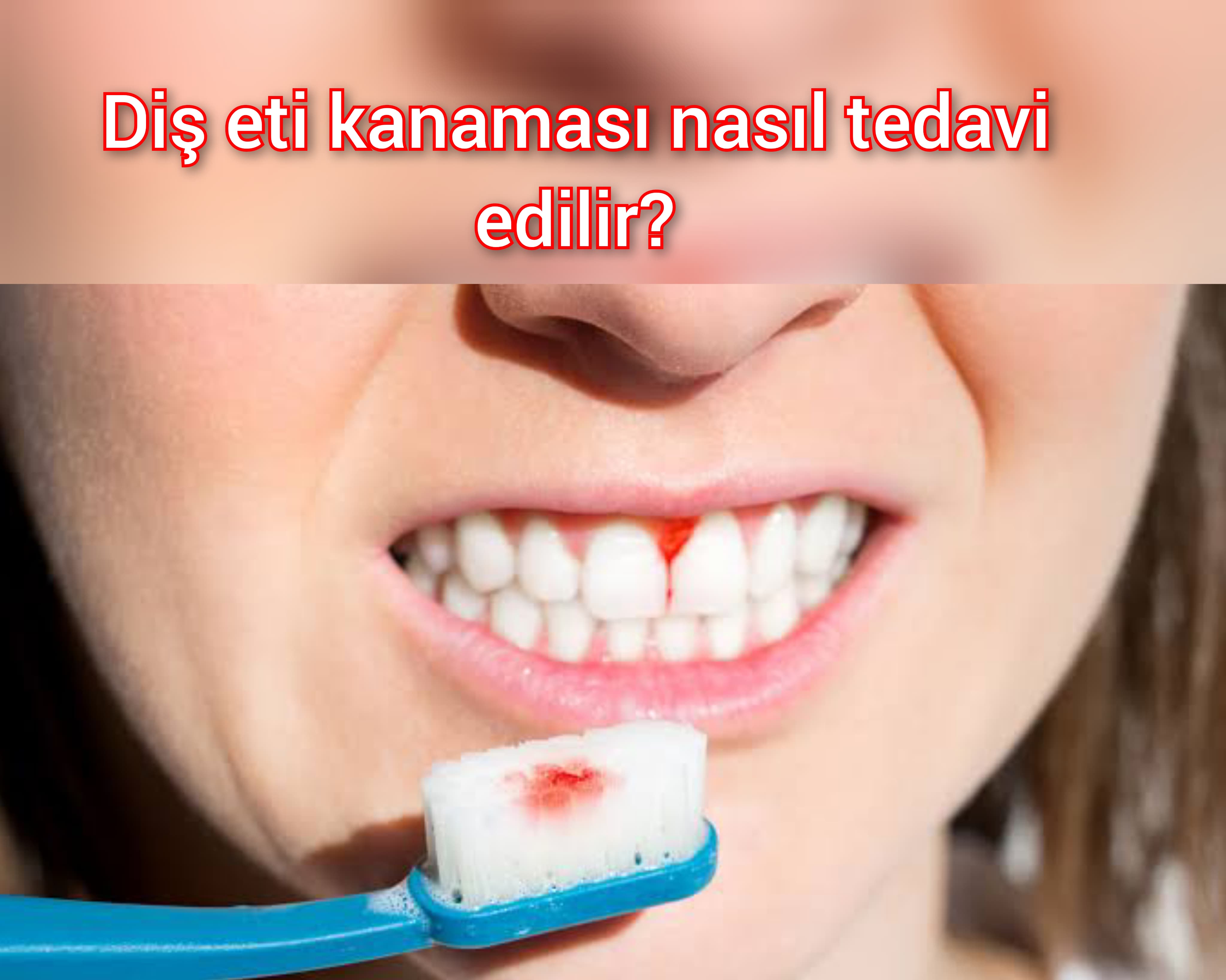 Diş eti kanaması nasıl tedavi edilir?