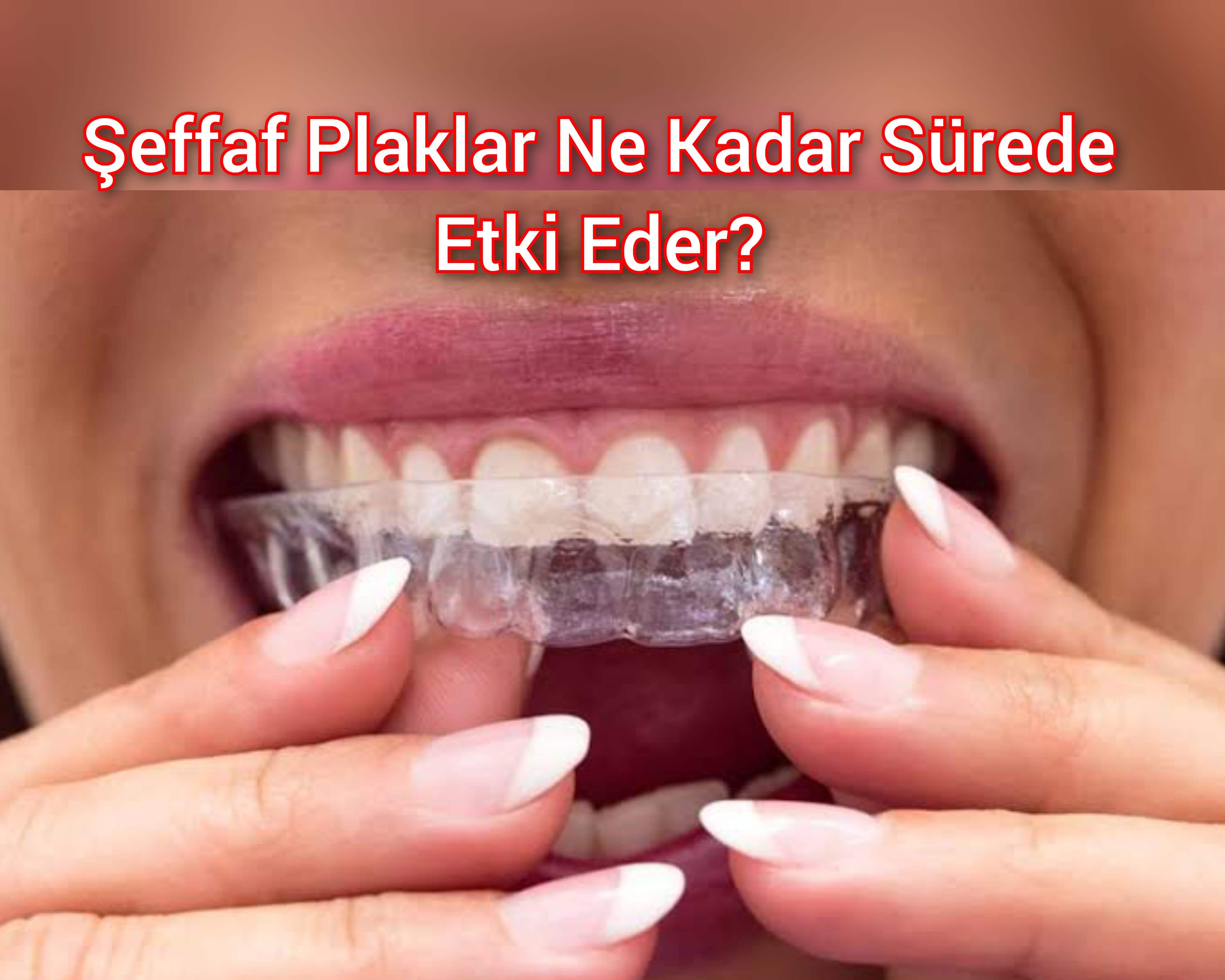 Şeffaf Plaklar Ne Kadar Sürede Etki Eder?