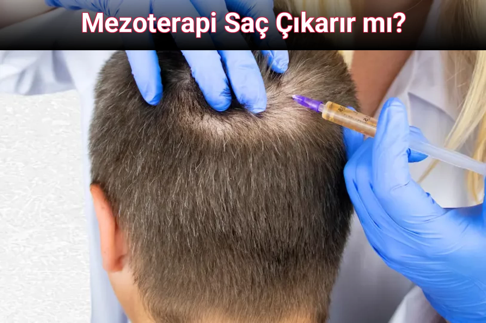 Mezoterapi Saç Çıkarır mı?