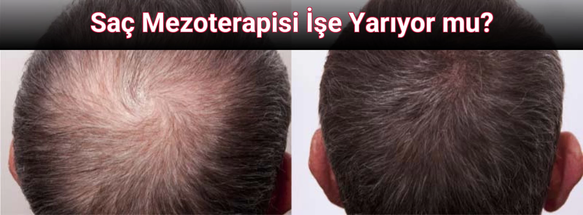Saç Mezoterapisi İşe Yarıyor mu?