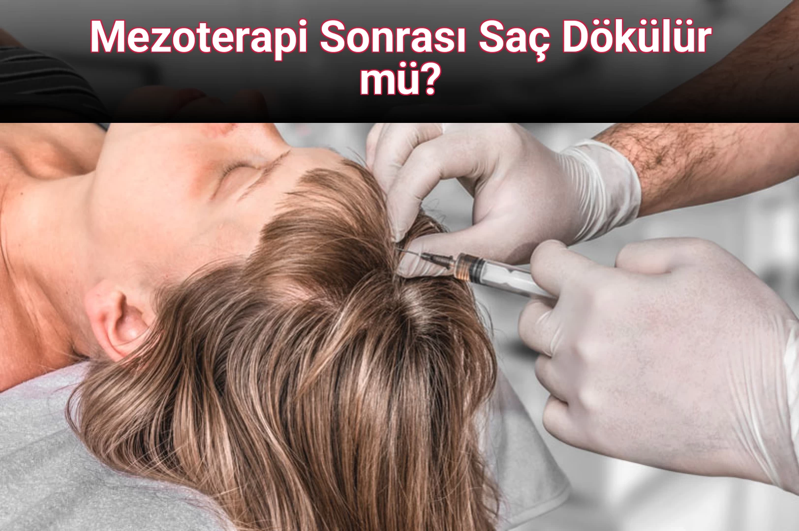 Mezoterapi Sonrası Saç Dökülür mü?