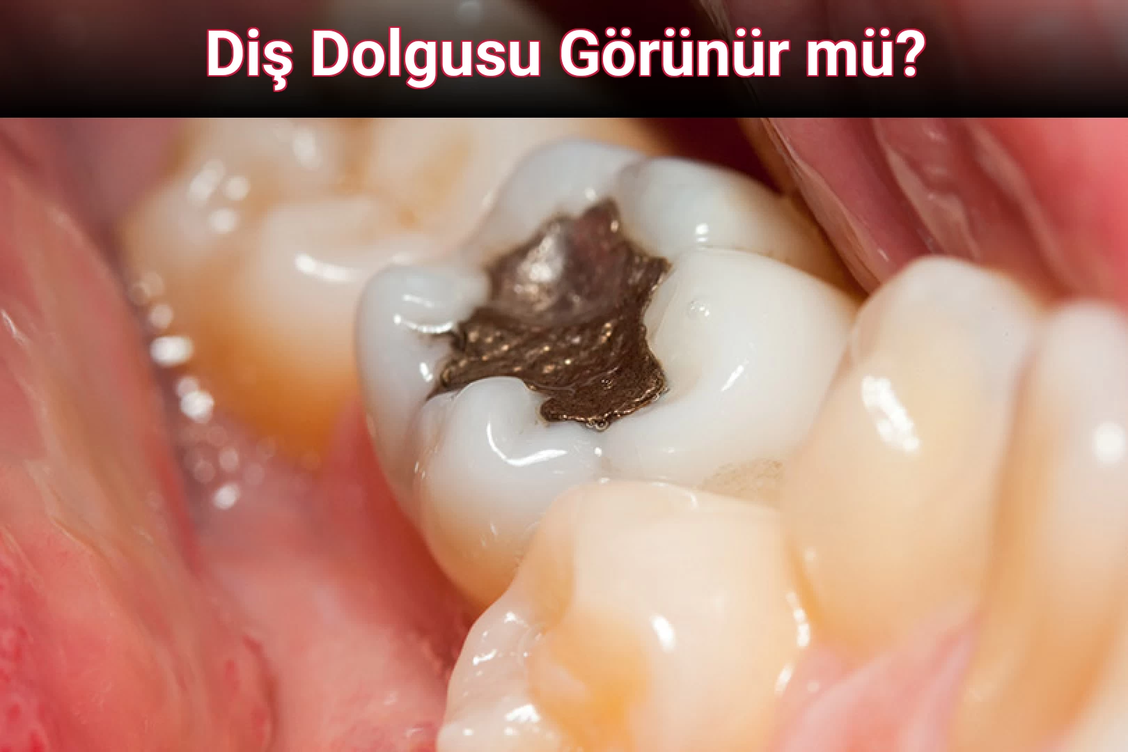 Diş Dolgusu Görünür mü?