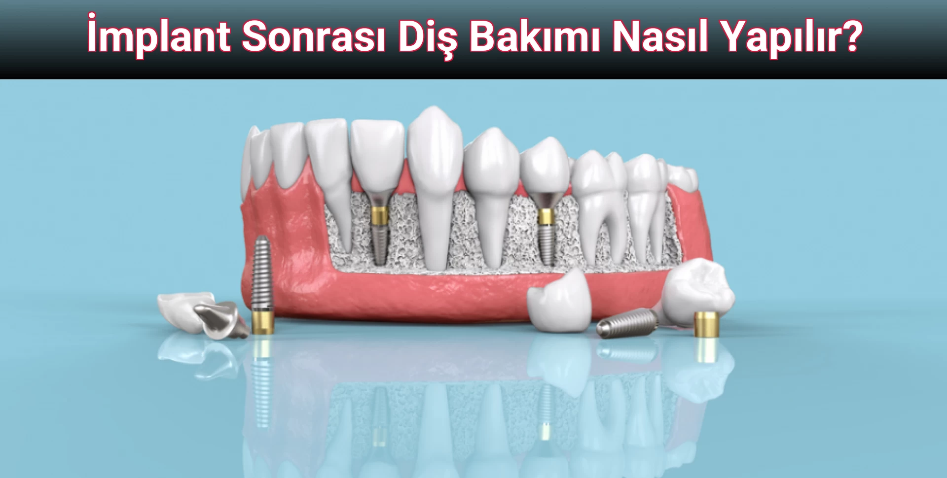 İmplant Sonrası Diş Bakımı Nasıl Yapılır?