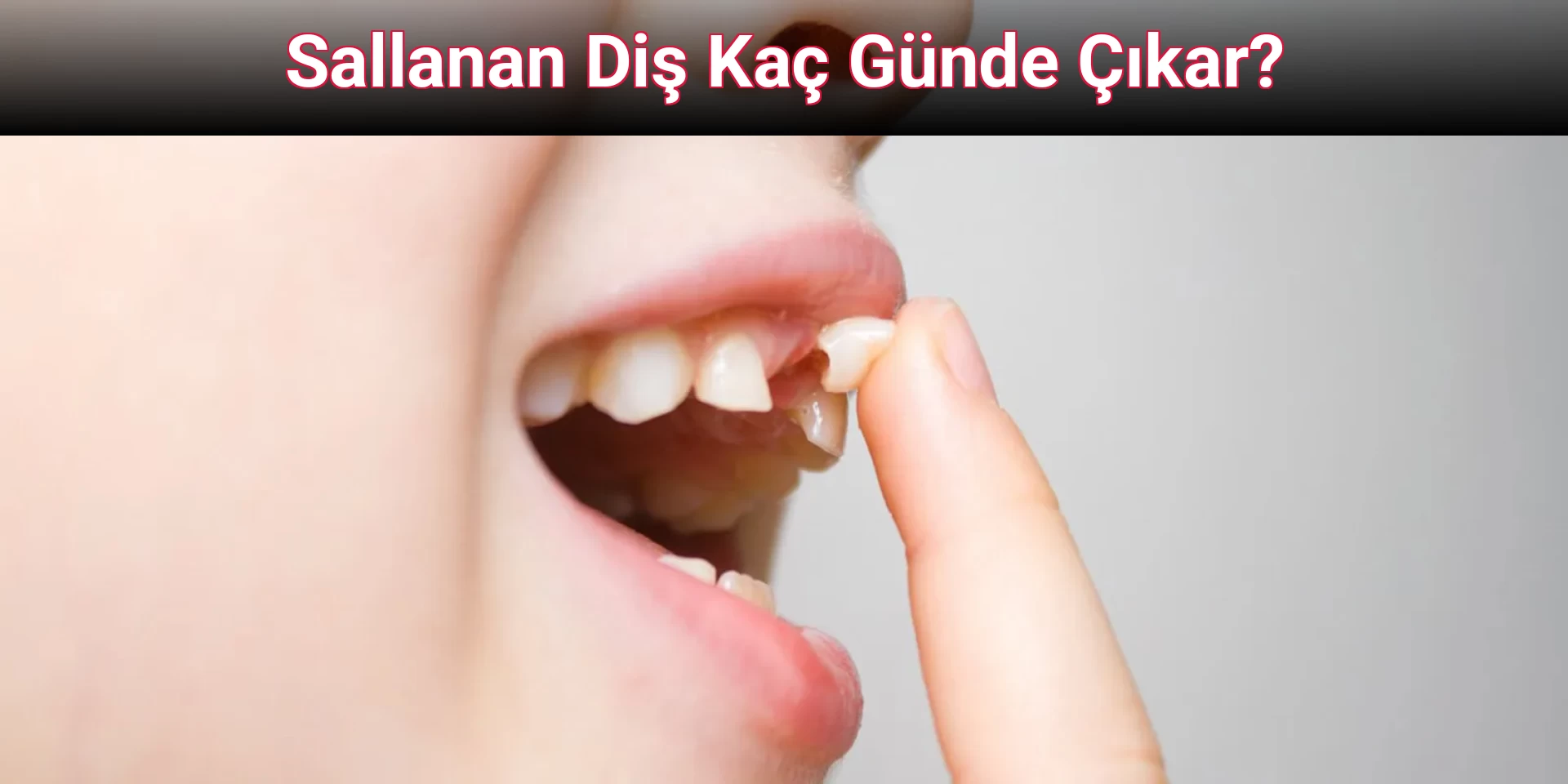 Sallanan Diş Kaç Günde Çıkar?