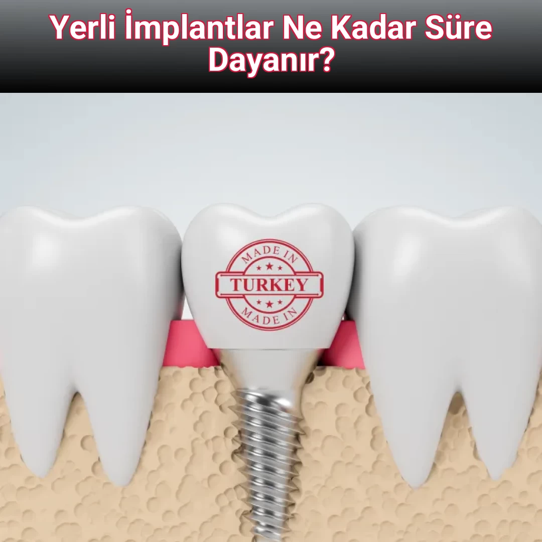 Yerli İmplantlar Ne Kadar Süre Dayanır?