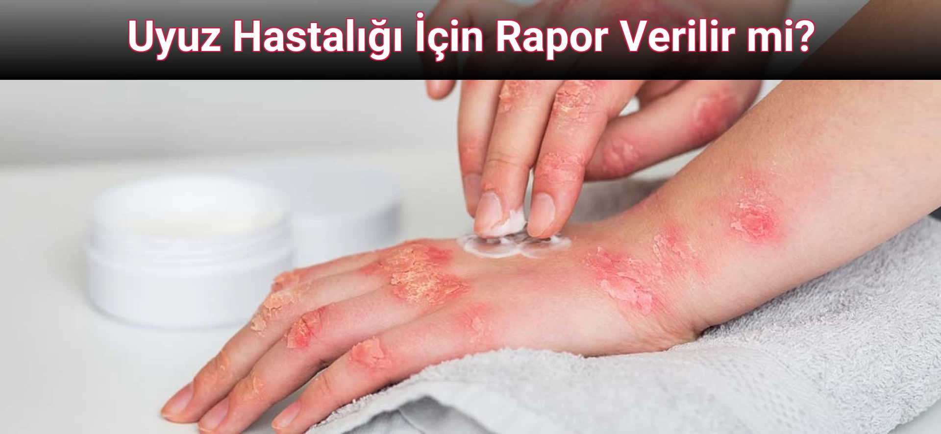 Uyuz Hastalığı İçin Rapor Verilir mi?