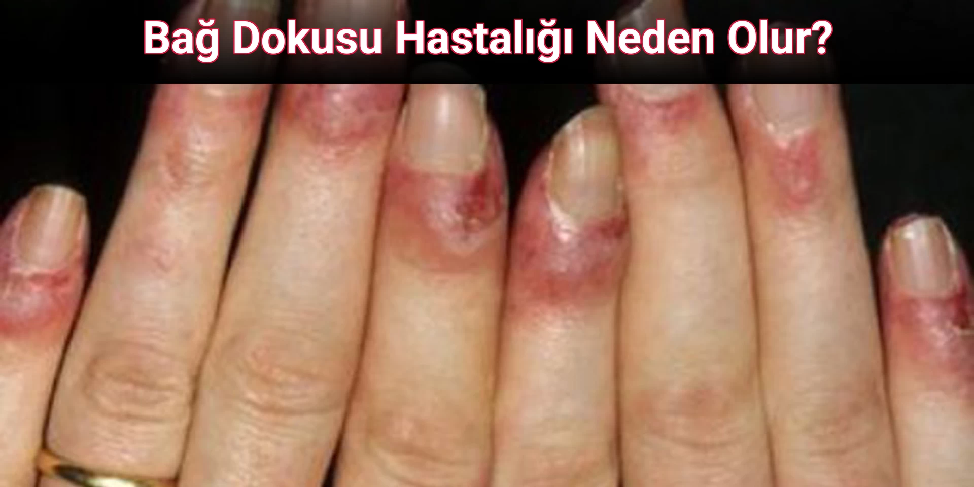 Bağ Dokusu Hastalığı Neden Olur?