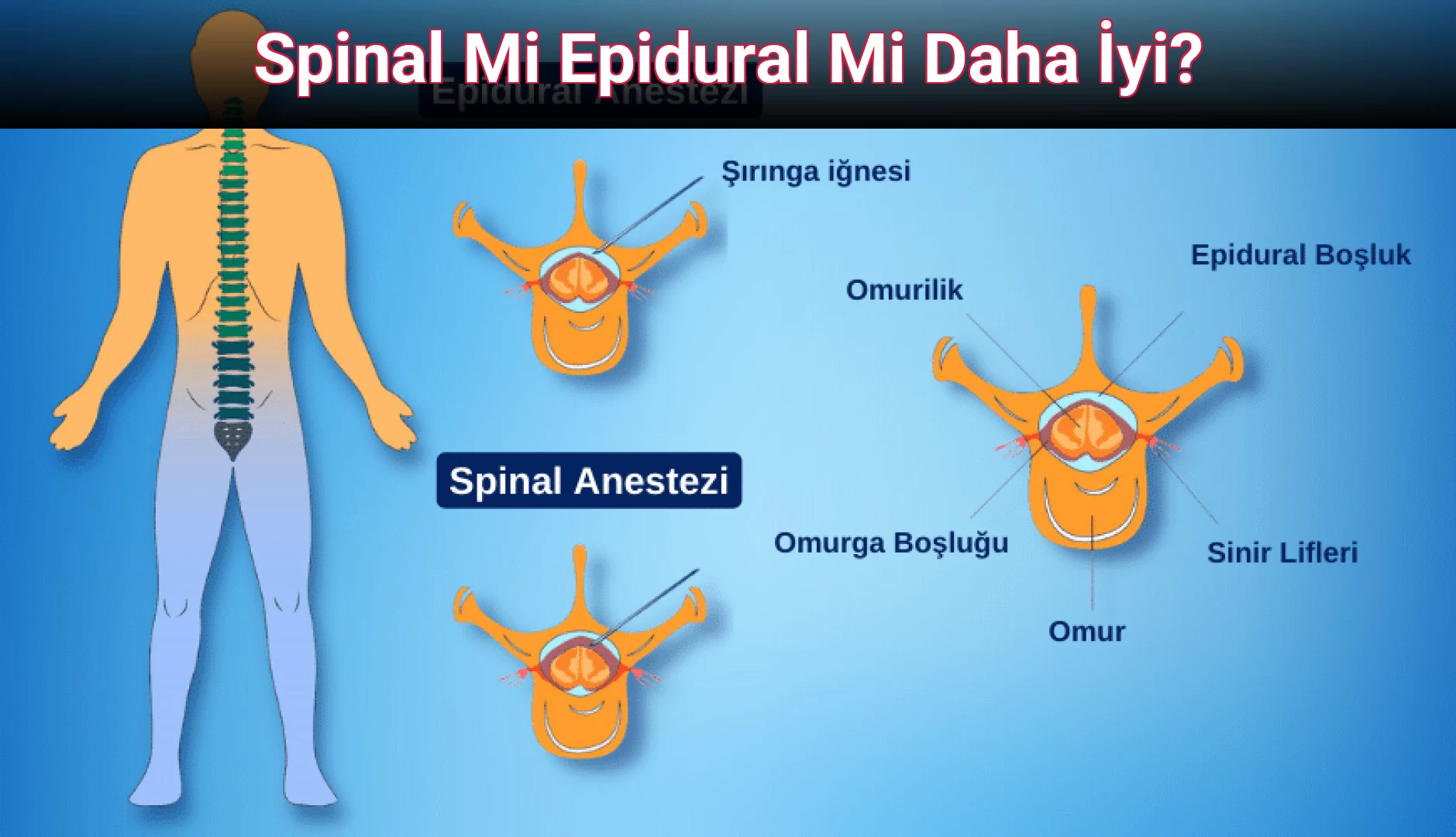 Spinal Mi Epidural Mi Daha İyi?