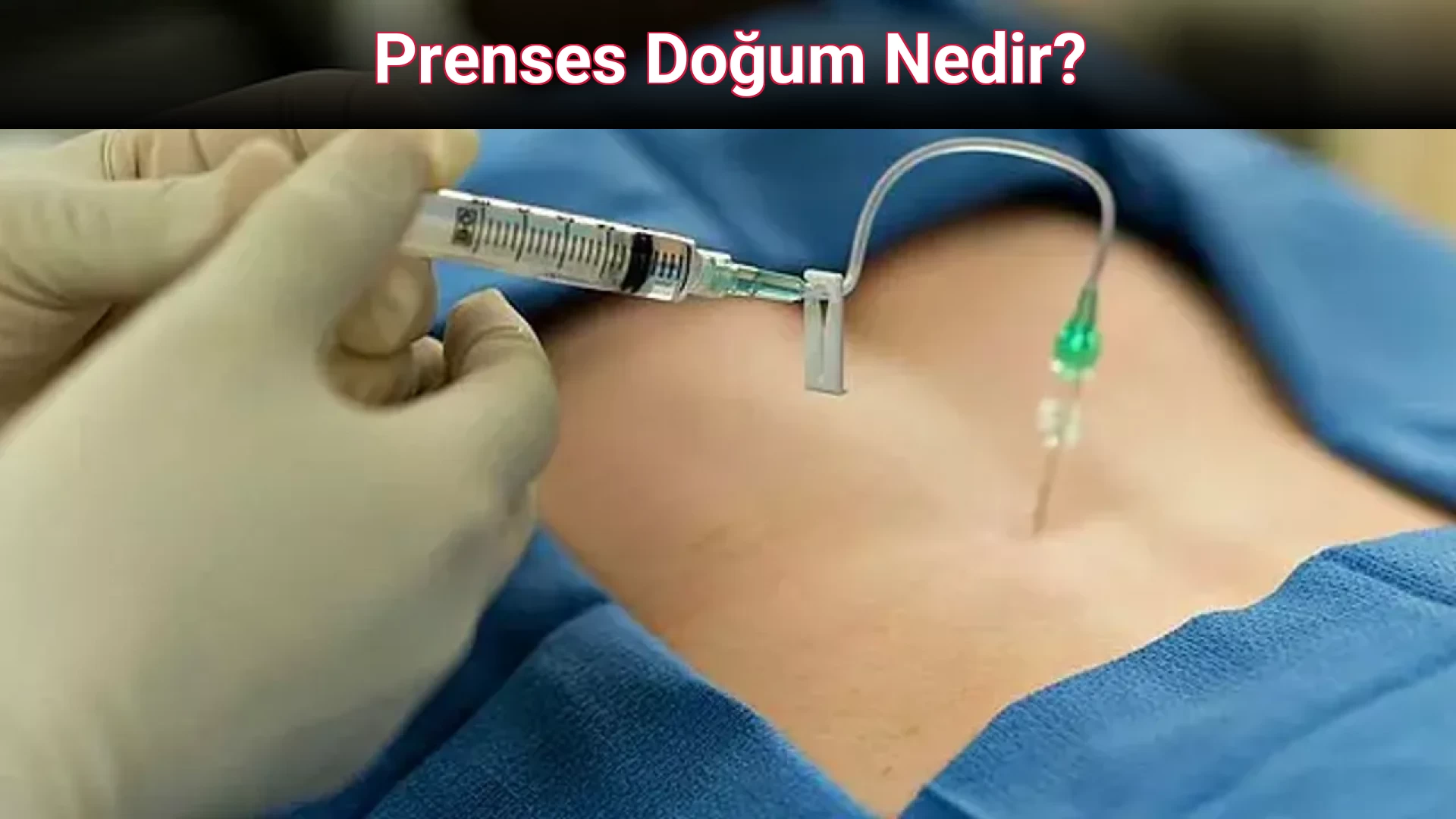 Prenses Doğum Nedir?