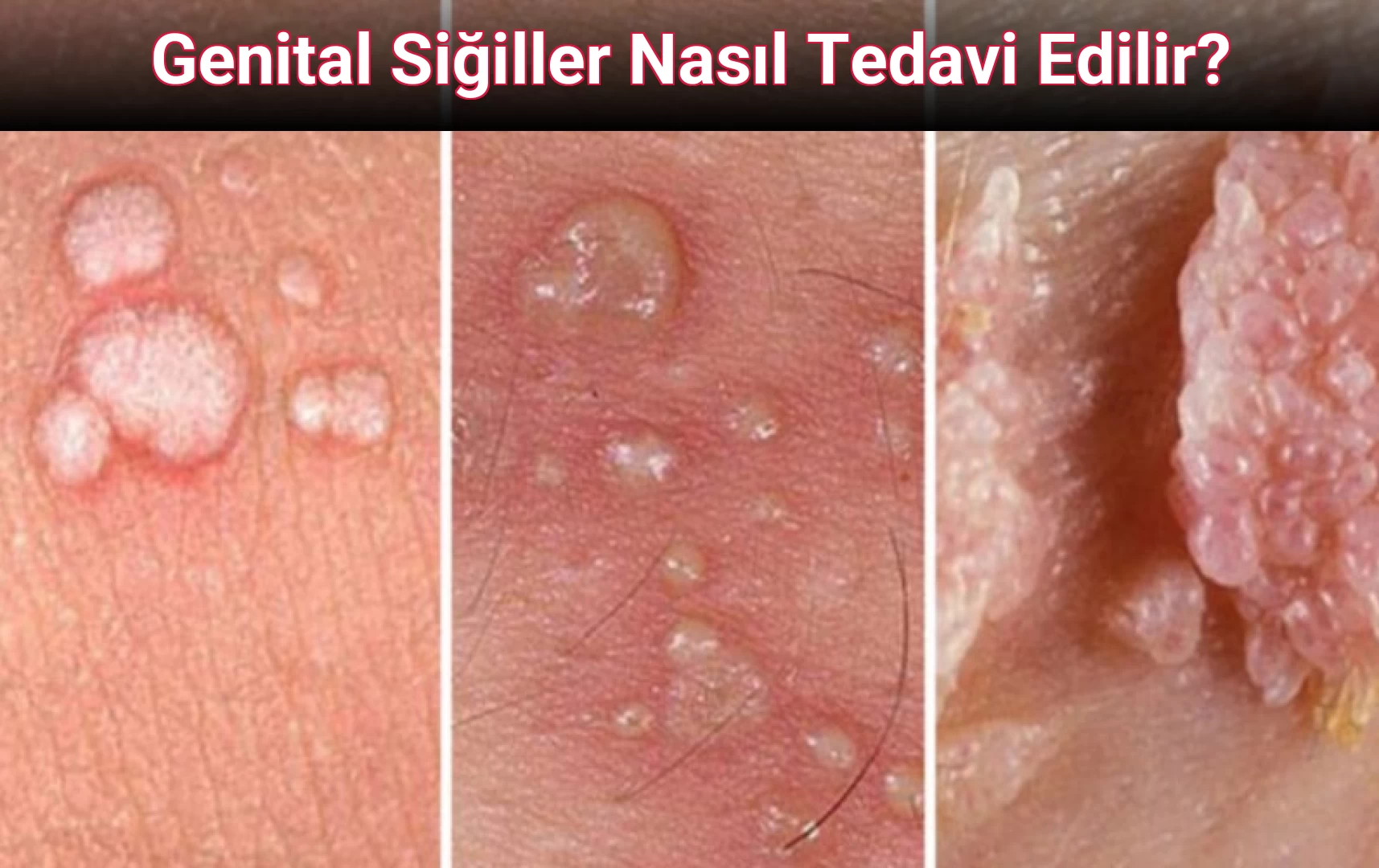 Genital Siğiller Nasıl Tedavi Edilir?