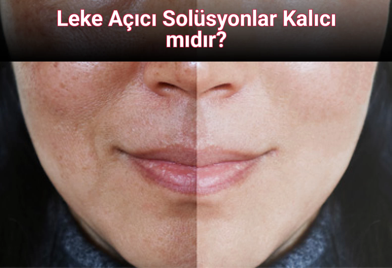 Leke Açıcı Solüsyonlar Kalıcı mıdır? 