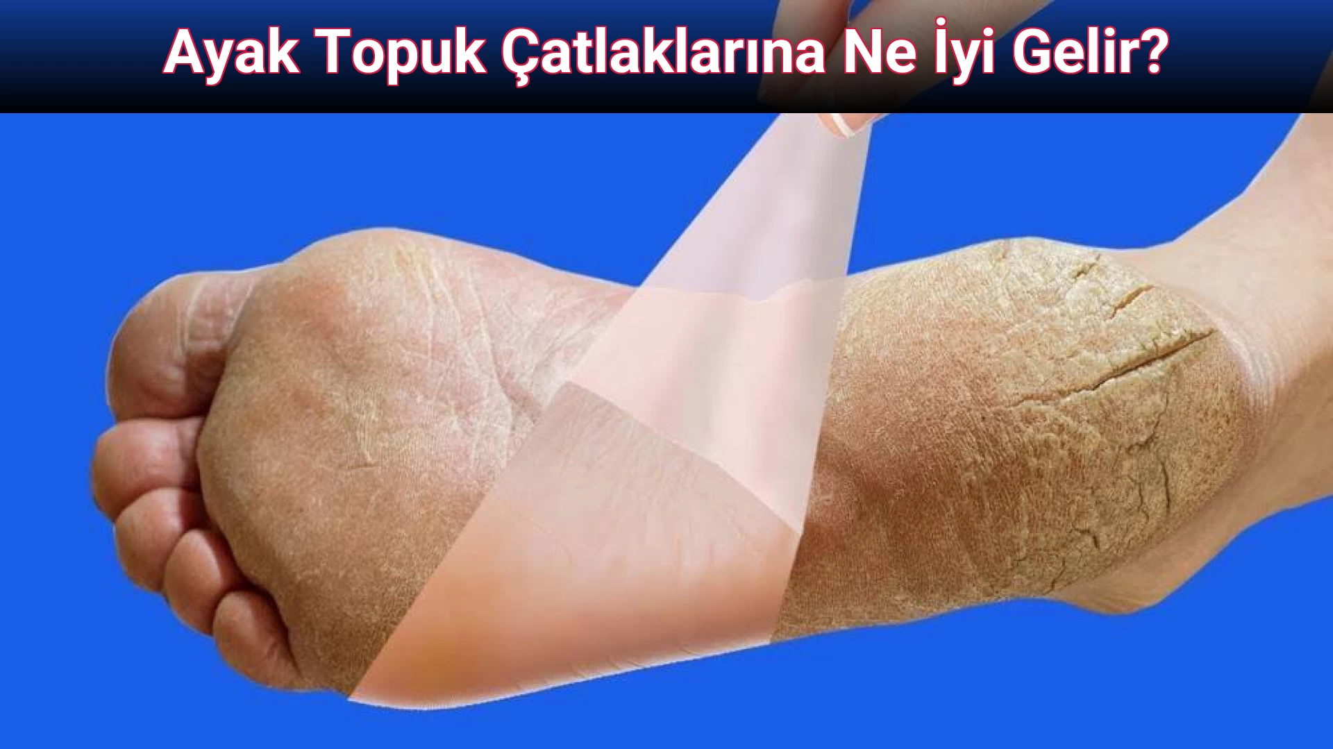 Ayak Topuk Çatlaklarına Ne İyi Gelir?