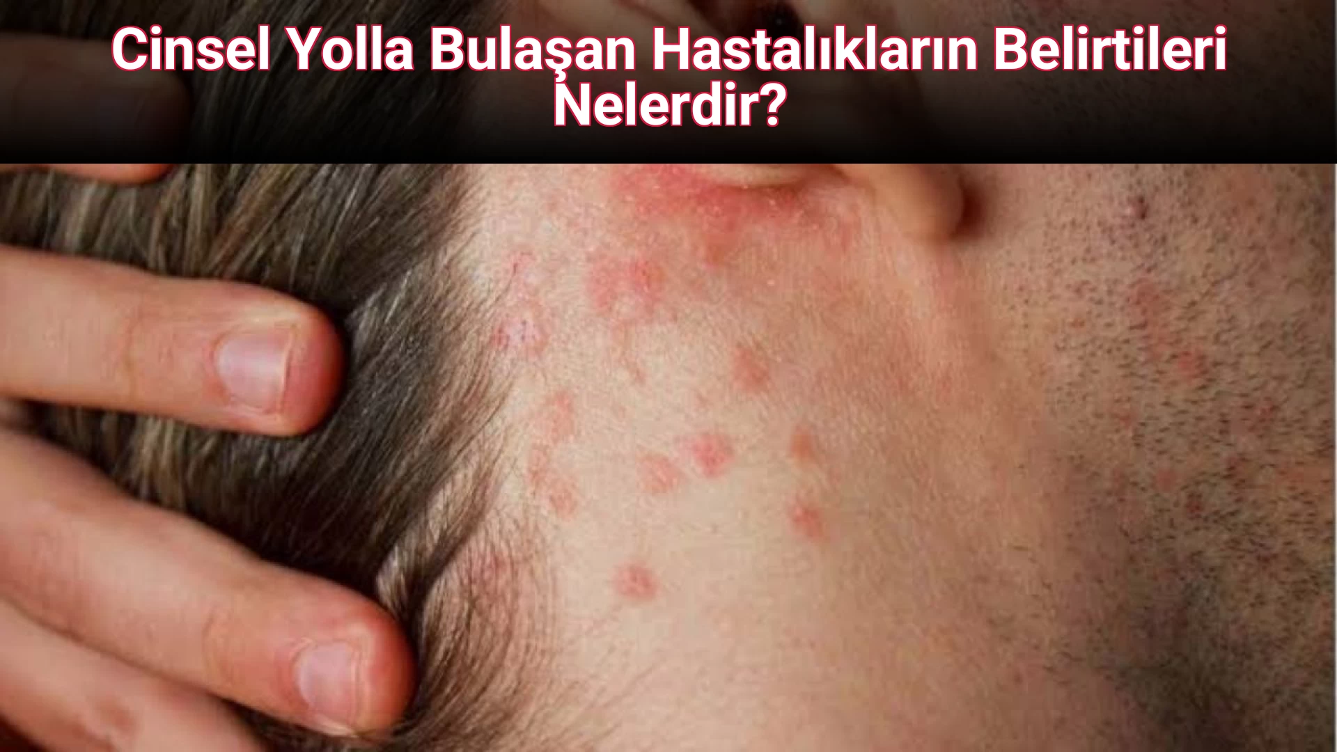 Cinsel Yolla Bulaşan Hastalıkların Belirtileri Nelerdir?