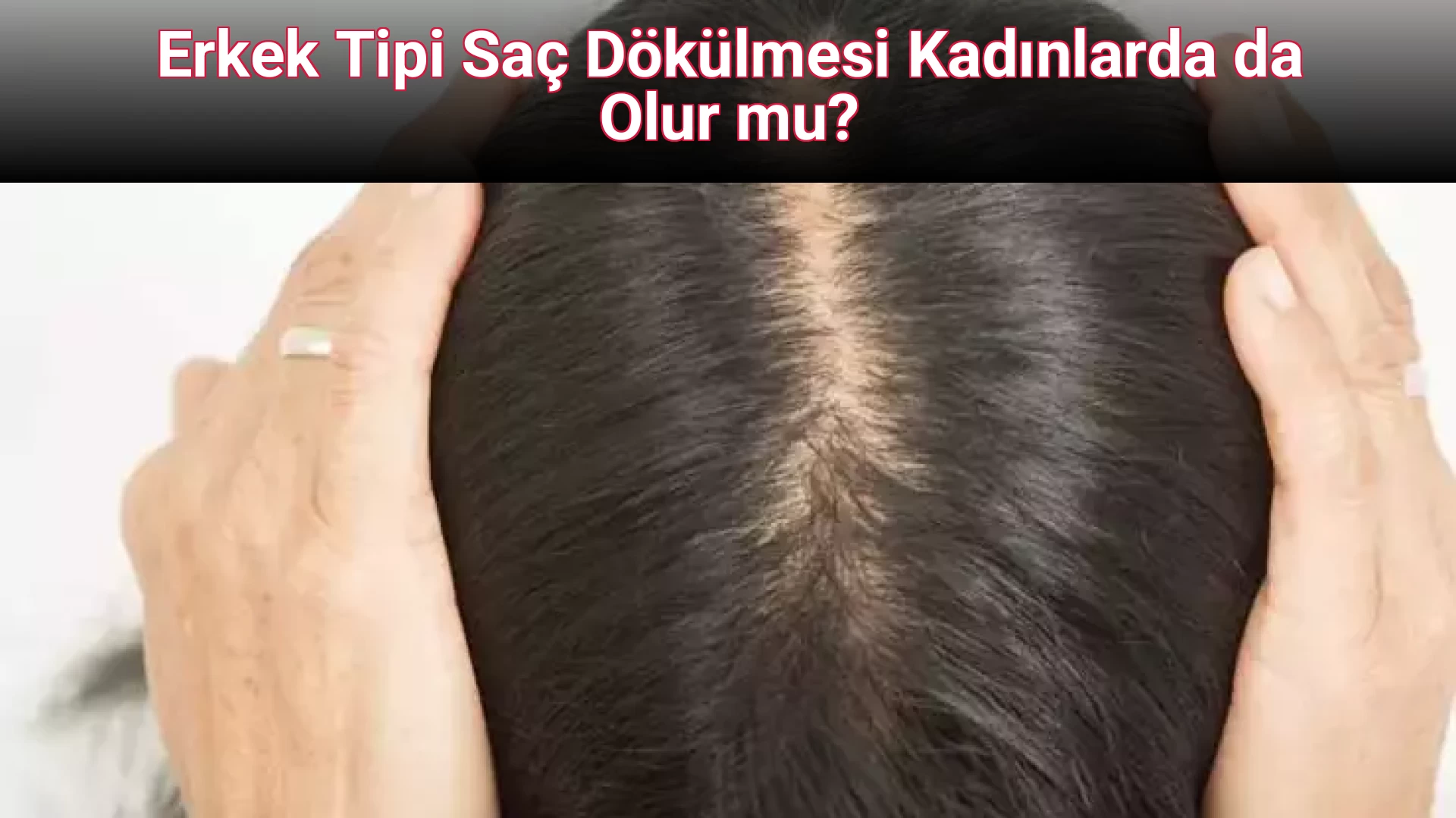 Erkek Tipi Saç Dökülmesi Kadınlarda da Olur mu?