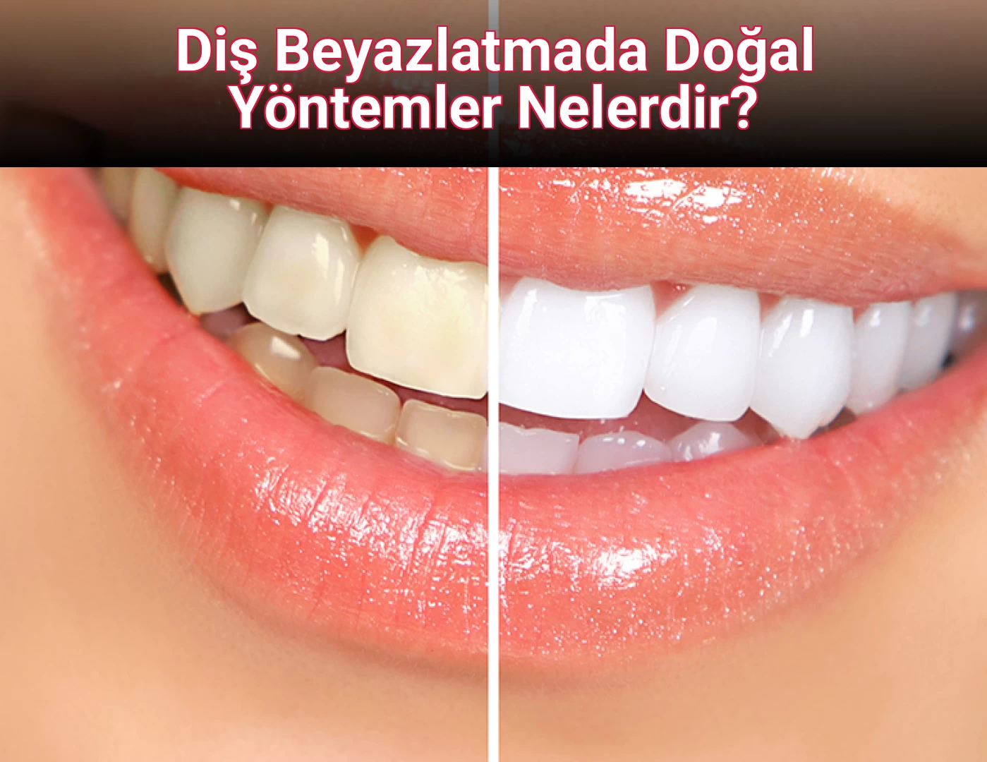 Diş Beyazlatmada Doğal Yöntemler Nelerdir?